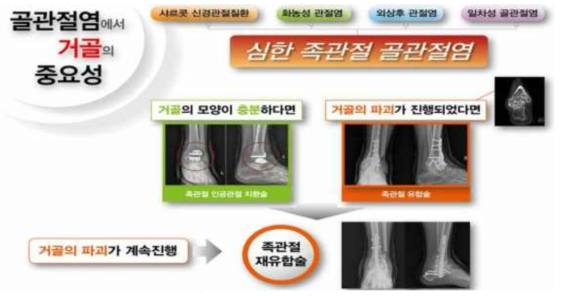 발목 골관절염에서의 거골 형상에 따른 시술 방법