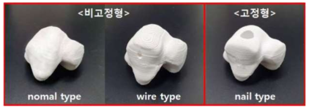 환자 맞춤형 인공발목관절 시제품 3종