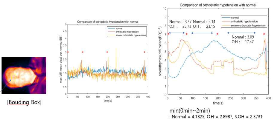 열화상 측정을 통한 기립성 저혈압 및 일반 대상군 비교