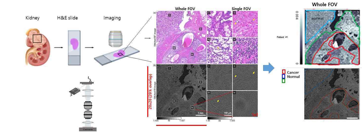 암 조직 슬라이드의 굴절률(RI) 영상과 H&E 염색 영상 확보 및 조직 구분