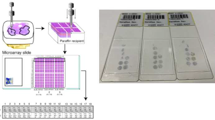 암 환자로부터 암 조직 TMA 슬라이드