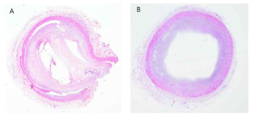 H&E staining of left anterior descending artery sections of (A)Acute myocardial infarction group and (B)Control Group