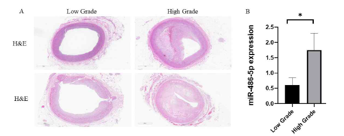 Histology of the LAD and expression of miR-486-5p in the low and high grade atherosclerosis classified by AHA. (A) The complex plaques that involve hemorrhage or were calcified were observed in high-grade atherosclerosis (x200). (B) In MI cases of high-grade atherosclerosis (classified by AHA), miR-486-5p is expressed significantly higher thatn low-grade group. Values are shown as mean±S.E.M. Statistically significant differences between low and high grade of atherosclerosis were determined using Mann-Whitney U test, *p = 0.0216 AHA, American Heart Association