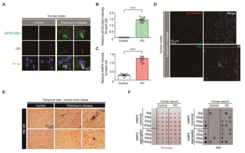 AIMP2 응집의 파킨슨병 임상 연계성 (A-C) 파킨슨환자 부검뇌조직 (temporal lobe)의 루이소체 및 AIMP2 응집체의 분포를 pS129-αSyn과 5B2 항체를 이용한 이중면역형광 이미징으로 확인 및 정량 그래프 (D) 루이소체와 AIMP2 응집체의 분포를 각각의 특이 표지 항체를 이용한 이중면역형광 염색 후 confocal 이미징으로 확인. (E) 파킨슨환자 및 정상인의 뇌조직에 대한 5B2 항체를 이용한 면역조직 염색 이미지 (F) 정상 및 파킨슨 환자의 혈장에서의 AIMP2 응집체의 발현을 5B2 항체 기반 dot blot 분석을 통해 확인함