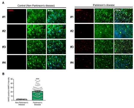 PD 환자 측두엽 뇌조직에서의 AIMP2 축적. A. 파킨슨 환자와 유사한 연령대의 대조군으로부터 얻은 부검 뇌조직에서의 신경세포 수상돌기 마커인 MAP2와 AIMP2에 대한 특이 항체 를 활용하여 면역 형광 이미징 (n =4 per group). (B) 파킨슨 환자와 대조군의 측두엽 뇌 조직에 대해서 MAP2 레이블링된 신경 세포에서의 AIMP2 발현량 정량 그래 프 (n = 60 brain sections from Con 6, 60 brain sectios from PD 6)