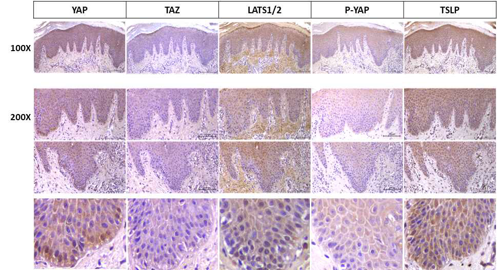 아토피피부염 환자 피부에서 YAP, TAZ, LATS, P-YAP 단백질들 및 TSLP의 발현