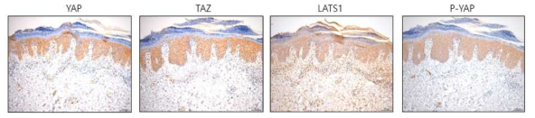 건선 환자 조직에서 LATS1/2, P-YAP, YAP, TAZ의 발현 비교