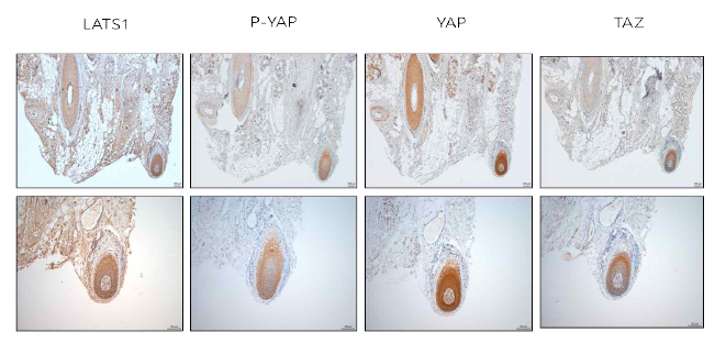 탈모 환자 조직에서 Hippo pathway 인자 발현도