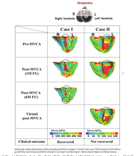 : 서클라지 수술 전 후의 환자 맞춤형 심장모델이 받는 스트레스 분포도