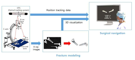 제안한 영상 기반 3차원 골절 모델링을 통한 수술 내비게이션