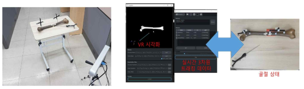 대퇴부 팬텀을 이용한 가상현실 기반 골절 수술 내비게이션