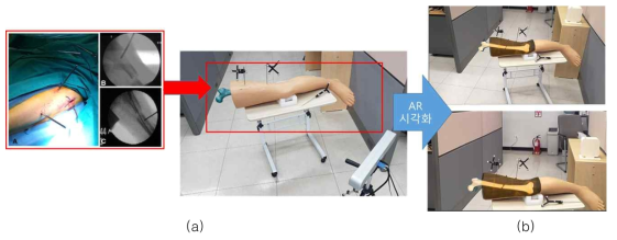 팬텀을 이용한 골절 내비게이션 테스트 (a) 최소 침습 수술을 모사한 팬텀 실험 환경 세팅 (b) 증강현실을 적용한 대퇴부 골절의 시각화