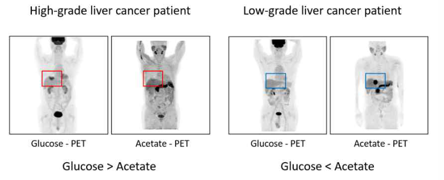 간암환자의 grade 별 PET-image