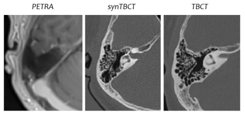 후속연구 3에서 생성한 synthetic temporal bone CT의 예