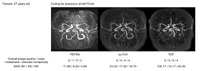 좌측후교통동맥 동맥류에 대해 코일색전술을 받은 환자에서 시행한 PETRA(좌측)와 TOF(우측) 영상 및 cycleGAN 모델에 PETRA 영상을 적용하여 구현한 synthetic TOF(중간) 영상. 영상의 질, 선명도가 향상되고, 신호 잡음이 감소함