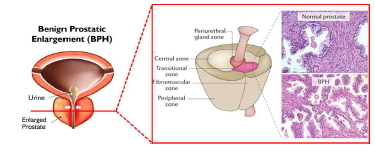 전립선 비대증 조직 소견 및 전립선 내부 세부 조직 모식도
