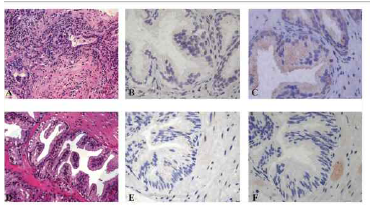 전립선 비대증 환자에서 LC3B (B, E)및 p62(C, F)발현에 관한 연구(Cosmo. DN et al.)