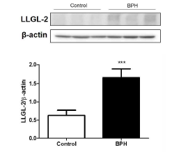 전립선 비대증 조직에서 LLGL-2 유전자의 발현