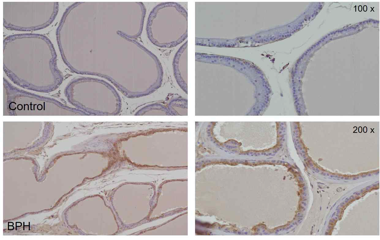 면역조직화학 염색을 통한 전립선 비대 조직에서 LLGL-2 유전자의 발현 (위) 정상전립선 조직 (아래) 전립선 비대 조직