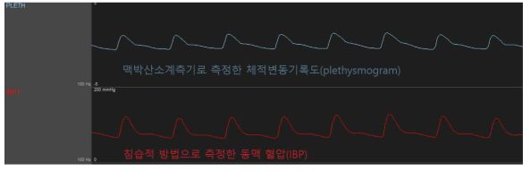 맥박산소계측기의 체적변동기록도와 침습적 동맥 혈압의 파형 비교