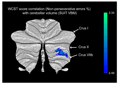 WCST nonperseveratiave error%는 cognitive cerebellum (crus II, VIIb)의 volume과 음의 상관관계, cortico-ponto-cerebellar pathway connectivity와 음의 상관관계를 보임