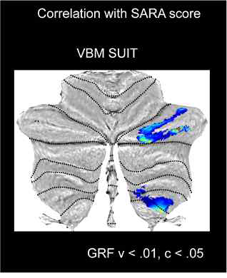 cerebellar ataxia의 motor severity (SARA score)와 유의한 상관관계를 보임