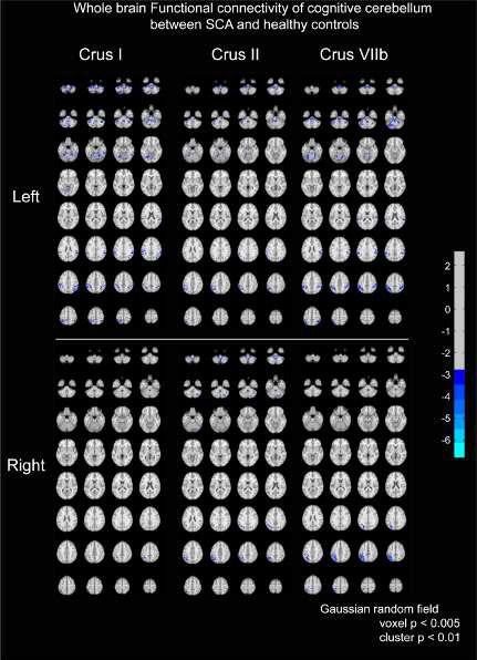 left and right cognitive 소뇌 (crus I, II 및 VIIb)를 seed로 하여 whole-brain 기능적 연결성 (FC)을 분석. CA군은 뇌교, 중소뇌각, 소뇌소엽, 상측측두엽, 변연상이랑, 상두정피질을 동반한 감소된 FC를 보였음