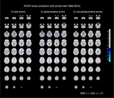 소뇌 위축과 관련있는 WCST 점수와 피질 GM의 상관 관계