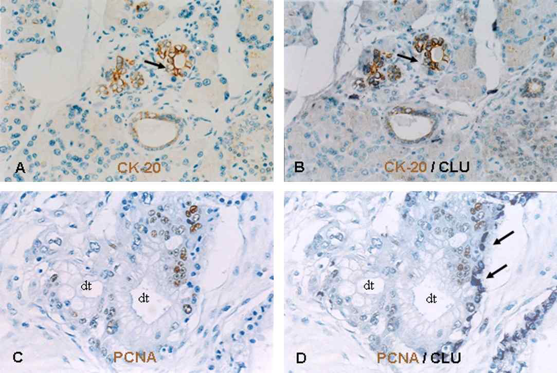 췌장암 조직에서 Clusterin 발현 세포의 특징 분석 – 췌장암 조직에서 이중 염색법을 이용한 Clusterin / CK20 (A, B) 및 Clusterin / PCNA (C, D)의 발현 분포