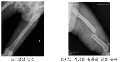 골절 영상 검출에 관한 연구