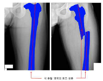 뼈 영역 정렬을 위한 포즈 성분