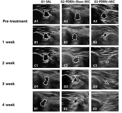 Sequential changes in ultrasound finding of subscapularis tendon tear at Pre-treatment, 1-, 2-, 3- and 4-week post-treatment. Ultrasonographic (A1–E3) findings of the subscapularis tendons in G1-SAL, G2-PDRN+Sham MIC, and G3-PDRN+MIC. (A1-A3) Pre-treatment images; (B1-E3) Post-treatment images. Abbreviations are SAL, 0·2mL Normal saline; PDRN, polydeoxyribonucleotide; MIC, Microcurrent therapy