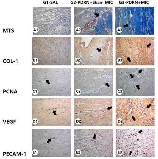 Immunohistochemical findings Immunohistochemical (A1-E3) findings of the subscapularis tendons in G1-SAL, G2-PDRN+Sham MIC, and G3-PDRN+MIC. (A1-A3) Newly regenerated tendons are shown in the blue-stained fibers (black arrow; Masson’s trichrome stain; X200) in G2-PDRN+Sham MIC, and G3-PDRN+MIC. Few regenerative collagen fibers were seen in G1-SAL. (B1-B3) Regenerated tendon fibers (black arrow; X200) were stained with anti-type 1 collagen antibody in G2-PDRN+Sham MIC, and G3-PDRN+MIC. Few regenerated tendon fibers were seen in G1-SAL. (C1-C3) Numerous PCNA stained cells (black arrow, X200) were observed in regenerated tendon fibers in G2-PDRN+Sham MIC, and G3-PDRN+MIC. Few PCNA stained cells were observed in G1-SAL (D1-E3) Numerous VEGF-positive cells and PECAM-1 positive microvascular densities (black arrows, X200) were observed in G2-PDRN+Sham MIC, and G3-PDRN+MIC. Few VEGF-positive cells and PECAM-1 positive microvascular densities were observed in group G1-SAL. Abbreviations are SAL : 0.2mL Normal saline; PDRN : polydeoxyribonucleotide; MIC: Microcurrent therapy; MTS : Masson's trichrome stain; COL-1 : Anti-type 1 collagen stain; PCNA: proliferating cell nuclear antigen; VEGF : vascular endothelial growth factor; and PECAM : platelet endothelial cell adhesion molecule