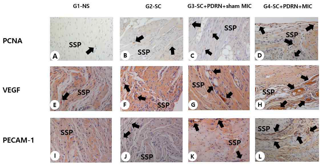 Histologic findings of the supraspinatus tendon. Numerus cell proliferating PCNA stained cells (black arrow, x 100) were observed in regenerated tendon fibers in G4-SC+PDRN+MIC. Lesser PCNA stained cells were observed in G2-SC, G3-SC+PDRN+sham MIC and few PCNA stained cells were observed in G1-NS (A to D). Numerous VEGF-positive cells and PECAM-1 positive microvascular angiogenesis densities (black arrow, x 100) were observed in G4-SC+PDRN+MIC. In G4-SC+PDRN+MIC, VEGF-positive cells and PECAM-1 positive densities are significantly greater than those of G3-SC+PDRN (E to L). Abbreviations are NS, Normal saline; SC, human umbilical cord blood-derived mesenchymal stem cell; PDRN, polydeoxyribonucleotides; MIC, Microcurrent therapy; PCNA, proliferating cell nuclear antigen; VEGF, Vascular endothelial growth factor; PECAM-1, Platelet endothelial cell adhesion molecule