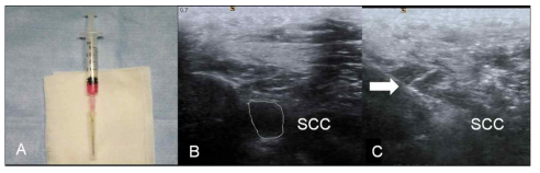 (A) umblical cord blood (UCB)-derived mesenchymal stem cells (MSCs). (B) T, subscapularis tendon. There is full-thickness tear in insertion of subscapularis tendon. (C) with in-plane method, injection is performed under ultrasound-guidance