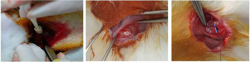 These figures show the techniques and equipment required to perform a 5mm diameter full-thickness rotator cuff tear by punch biopsy excision