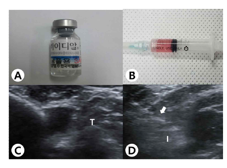 Human umbilical cord blood-derived mesenchymal stem cells, polydeoxyribonucleotide, and ultrasound images. (A) PDRN. (B) Human umbilical cord blood-derived MSCs. (C) Injection was made in the left shoulder subscapularis full-thickness tears under ultrasound guidance. (D) Longitudinal ultrasound image shows the needle (arrow) in the left shoulder SCC of the rabbit. Abbreviations: T, tendon; I, Injectant