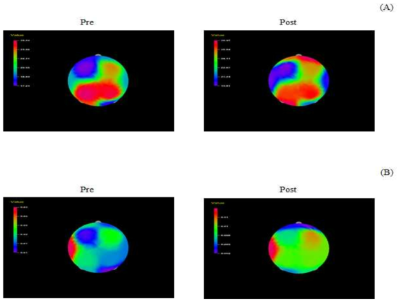 Brain mapping of beta wave by inhalation of 1% basil essential oil. (A) Absolute beta wave, (B) Relative beta wave