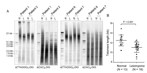 자궁근종의 텔로미어 단축. (A) 텔로미어의 서던 블롯 분석. 근종 (L)과 인접 정상조직 (N)에서 게놈 DNA 추출하여 HinF1으로 자른 후 전기영동함. DIG-라벨 된 d(TTAGGG)4 탐침자로 혼성화하였고, 탐침자 제거 후 DIG- 라벨된 d(CAC)8 탐침자와 혼성화함. DNA 사이즈 마커는 왼쪽에 표시함. (B) 자궁근종과 정상 조직에서 텔로미어 길이 비교. 각기 다른 기호로 환자 표시함. 정상 조직이 없는 5 개의 근종은 흑색 원으로 표시함. 수평선과 오차 막대는 각각 각 그룹의 평균 텔로미어 길이와 표준 편차를 나타냄. Student's t-test 사용됨. DIG, digoxigenin