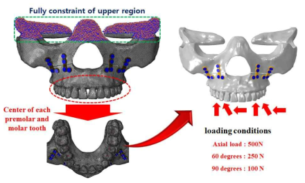 상악골 시술모델의 하중 조건