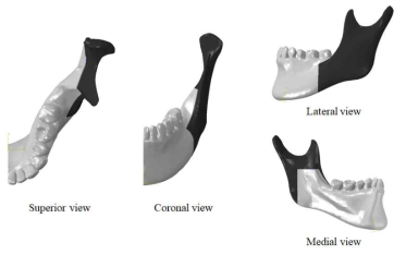 시상분할절골술을 적용한 하악골 유한요소모델