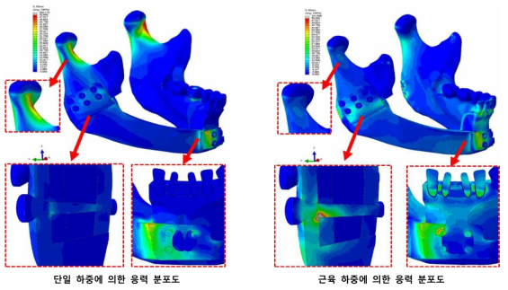 단일 및 근육 하중 조건에 따른 골에서의 응력 분포도