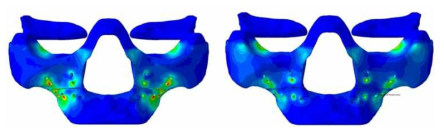 단일(왼) 및 근육(오른) 하중조건에서의 상악골의 응력 분포도