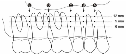 잇몸 경계로부터 6, 9, 12 mm 떨어진 지점에서의 치밀골의 두께 측정 방법
