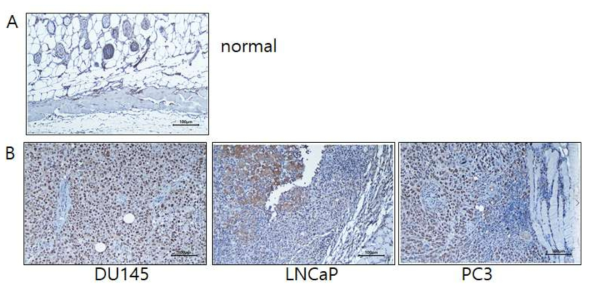 전립선암 세포주 xeno-graft에서의 PCNA IHC staining 결과