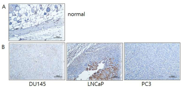 전립선암 세포주 xeno-graft에서의 E-Cadherin IHC staining 결과