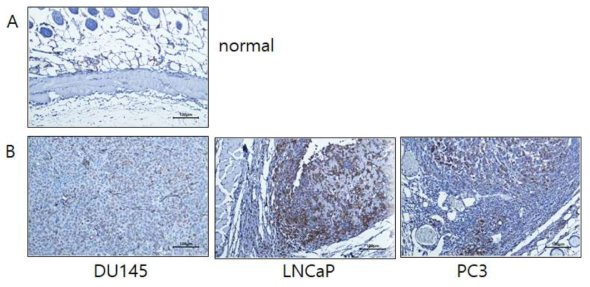 전립선암 세포주 xeno-graft에서의 Vimentin IHC staining 결과