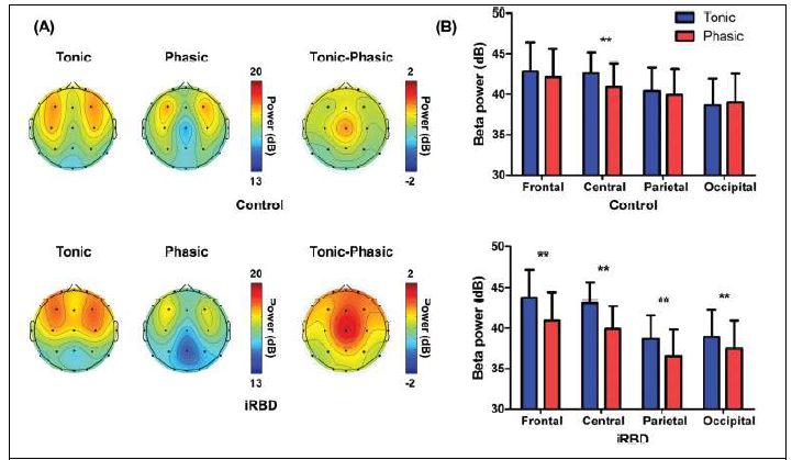 긴장 및 위상 렘수면 중 베타(15-30 Hz) 파워. (좌) 렘수면행동장애 환자군과 대조군의 베타파워 지형도. (우) 렘수면 상태에 따른 뇌영역별 베타 파워 비교(**P < 0.01)