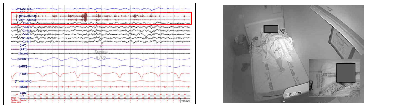 렘수면행동장애 환자의 수면다원검사 결과. (좌) 렘수면 중 턱 근전도(빨간색 박스)가 증가, 즉 렘수면 중 무긴장(RWA)이 관찰됨. (우) 비디오에서 수면 중 중얼거리면서 팔을 휘젓는 이상행동을 보임.