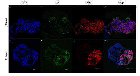 정상 유래, 환자 유래 유도만능 줄기세포주의 뇌 오가노이드 발달 비교 환자 유래 유도만능줄기세포와 정상 인 유래 유도만능줄기세포를 이용한 뇌 오가노이드의 신경발달 확인 (30 일, 공초점 현미경 이미지 분석). A: DAPI (Nuclei), B: Tuj1 (Neurons, neural marker), C: SOX2 (Neural stem cell marker), D: Merge. Scale bar = 200㎛